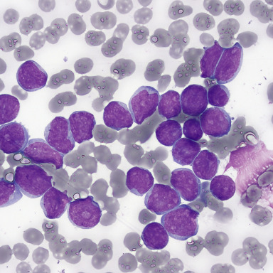 Médula ósea: biología de la leucemia